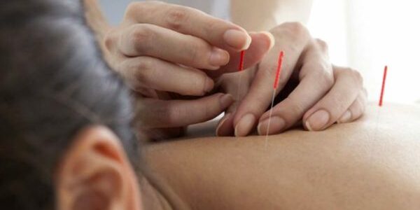 Tratamiento de acupuntura